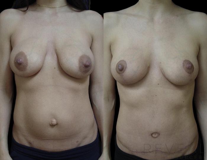 Before & After Breast Reduction Case 719 Left Side View in San Jose, CA