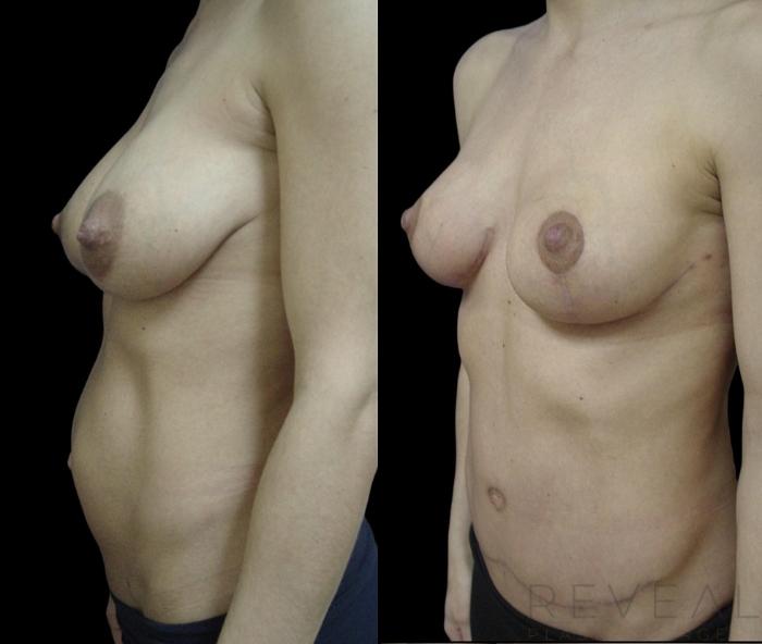 Before & After Breast Reduction Case 719 Right Side View in San Jose, CA