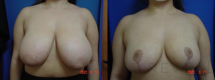 Before & After Breast Reduction Case 737 Front View in San Jose, CA