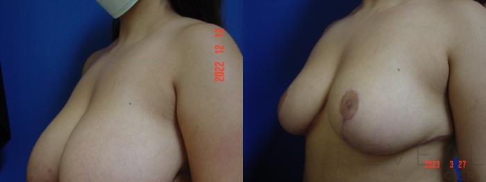 Before & After Breast Reduction Case 737 Left Side View in San Jose, CA