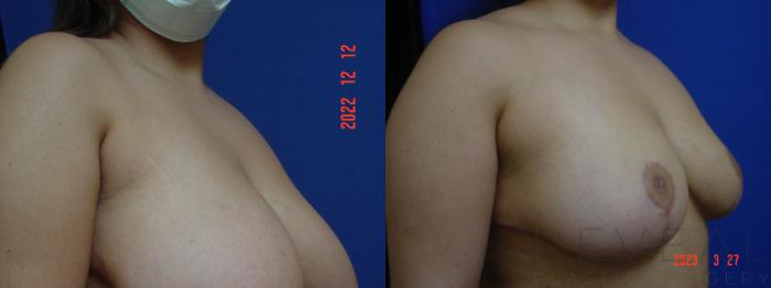 Before & After Breast Reduction Case 737 Right Side View in San Jose, CA