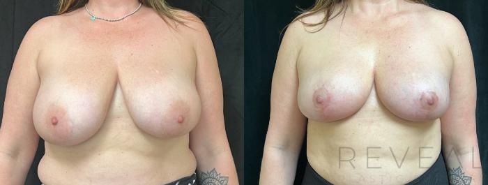 Before & After Breast Reduction Case 740 Front View in San Jose, CA