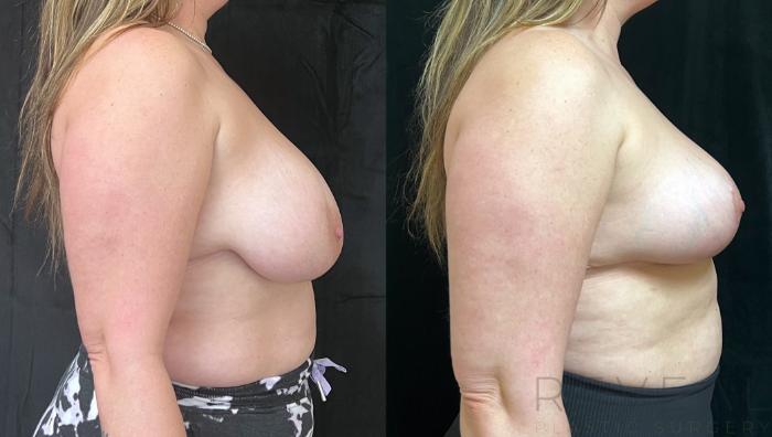 Before & After Breast Reduction Case 740 Left Oblique View in San Jose, CA