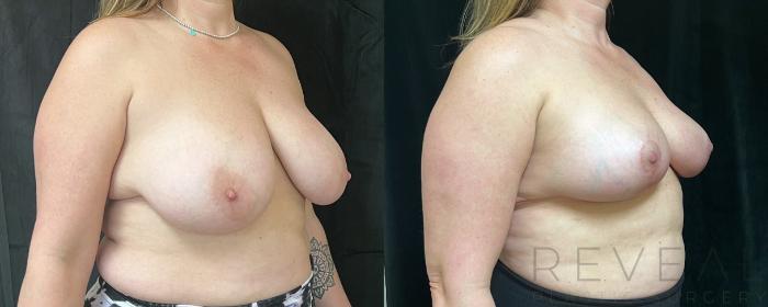 Before & After Breast Reduction Case 740 Left Side View in San Jose, CA