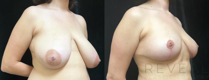 Before & After Breast Reduction Case 750 Left Oblique View in San Jose, CA