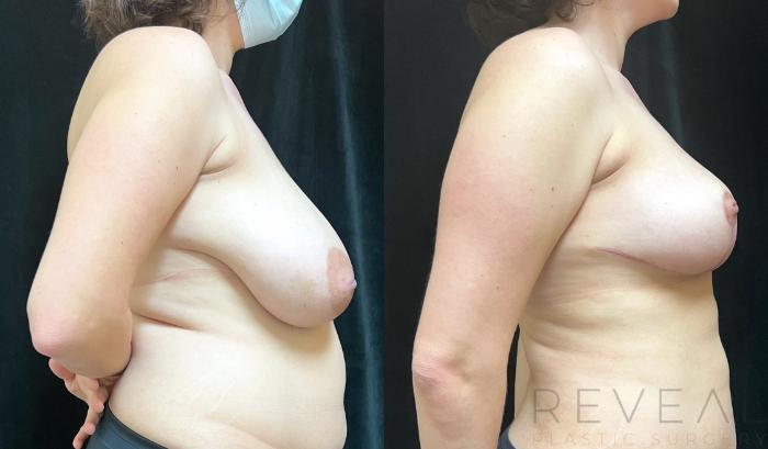Before & After Breast Reduction Case 750 Left Side View in San Jose, CA