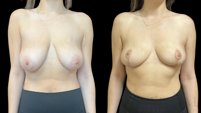 Before & After Breast Reduction Case 757 Front View in San Jose, CA