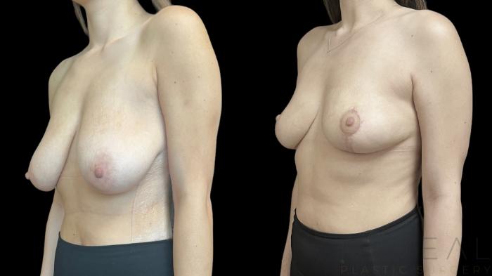 Before & After Breast Reduction Case 757 Left Oblique View in San Jose, CA