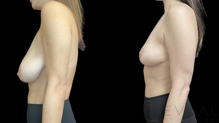 Before & After Breast Reduction Case 757 Left Side View in San Jose, CA