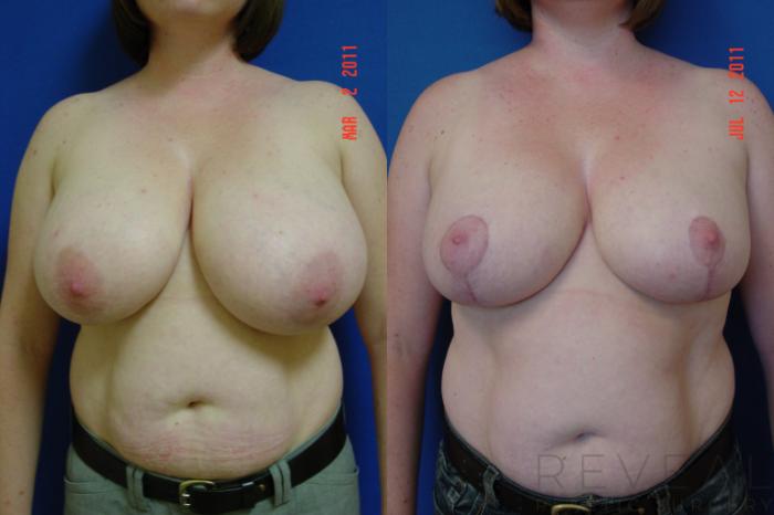 Before & After Breast Reduction Case 76 View #1 View in San Jose, CA