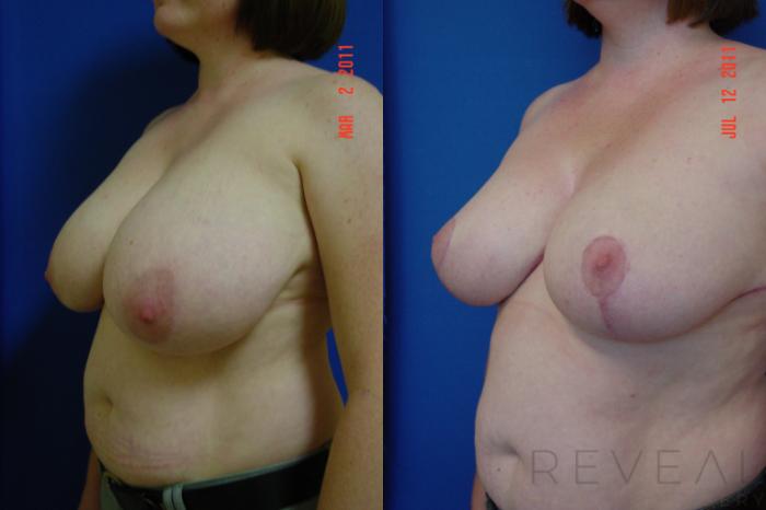 Before & After Breast Reduction Case 76 View #2 View in San Jose, CA