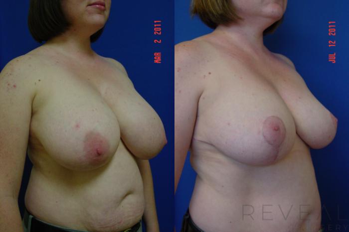 Before & After Breast Reduction Case 76 View #3 View in San Jose, CA