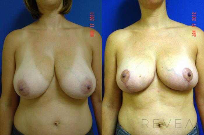 Before & After Breast Reduction Case 82 View #1 View in San Jose, CA