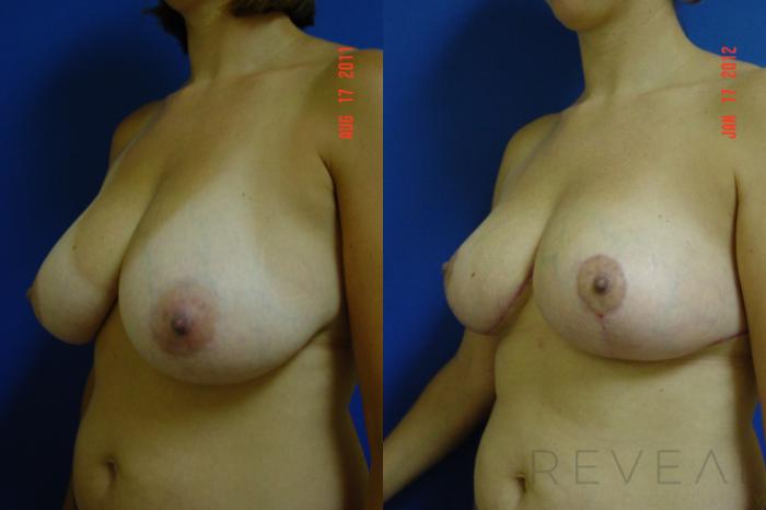 Before & After Breast Reduction Case 82 View #2 View in San Jose, CA