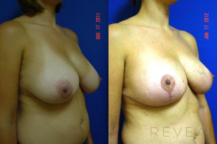 Before & After Breast Reduction Case 82 View #3 View in San Jose, CA