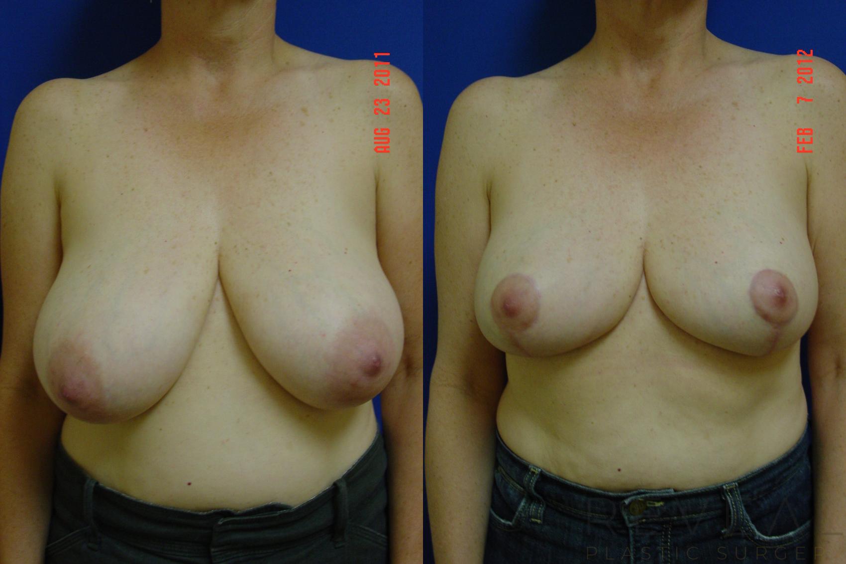 Before & After Breast Reduction Case 85 View #1 View in San Jose, CA