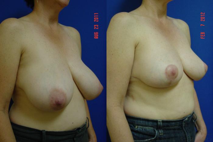 Before & After Breast Reduction Case 85 View #2 View in San Jose, CA