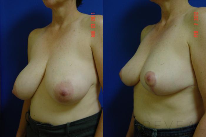 Before & After Breast Reduction Case 85 View #3 View in San Jose, CA