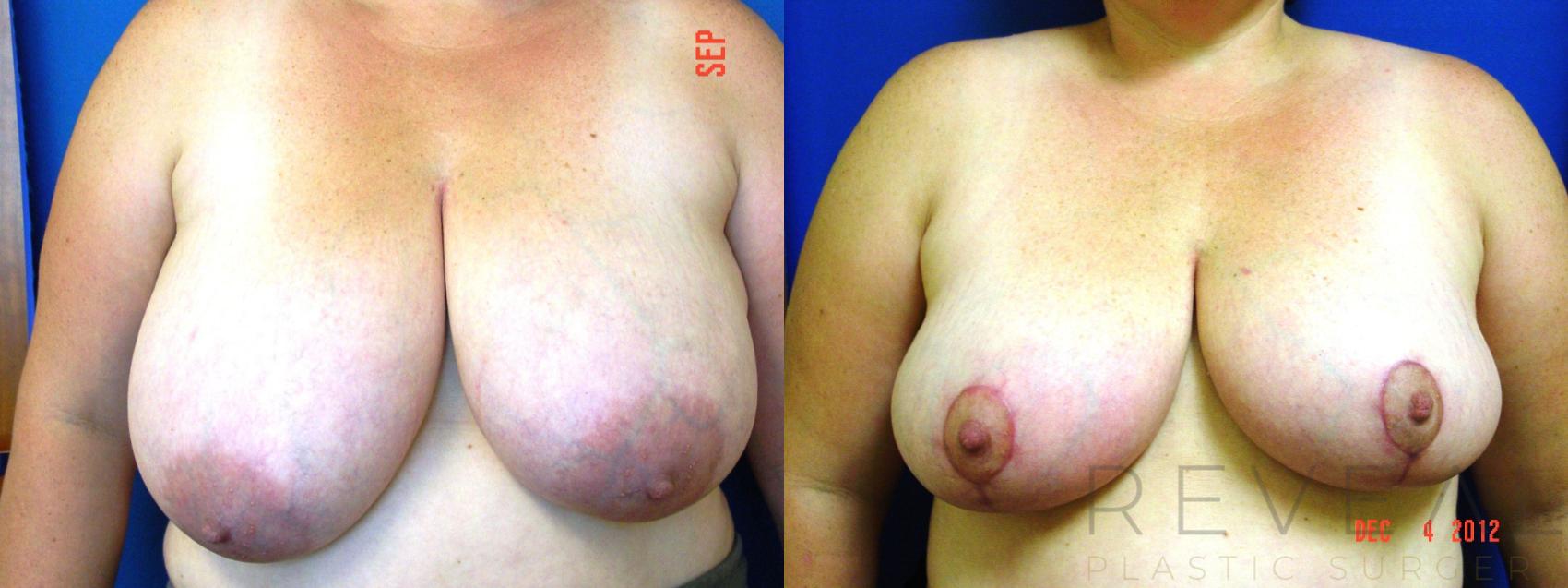 Before & After Breast Reduction Case 96 View #1 View in San Jose, CA