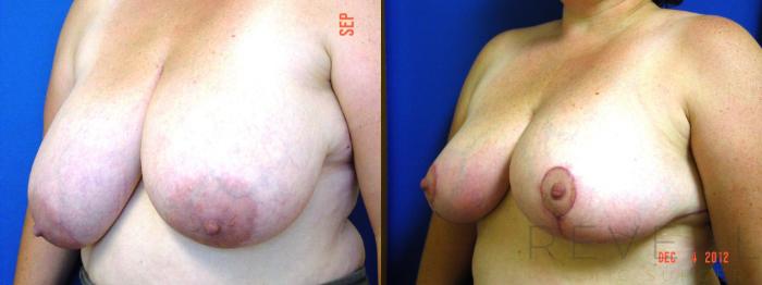 Before & After Breast Reduction Case 96 View #2 View in San Jose, CA