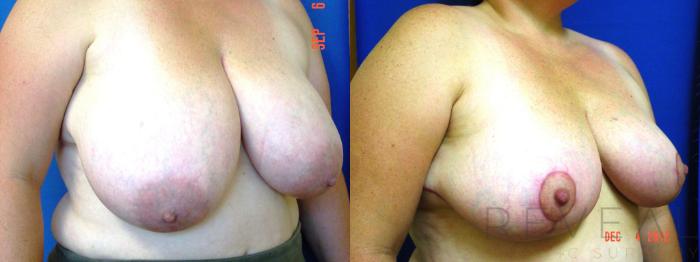 Before & After Breast Reduction Case 96 View #3 View in San Jose, CA