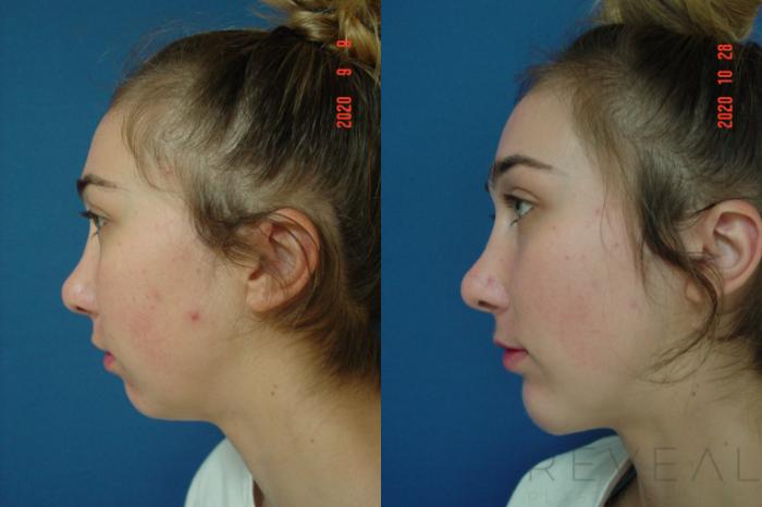 Before & After Chin Augmentation Case 443 View #1 View in San Jose, CA