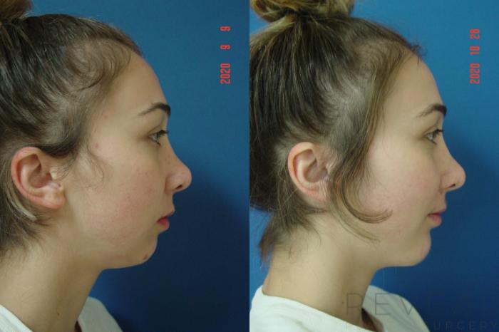 Before & After Chin Augmentation Case 443 View #2 View in San Jose, CA