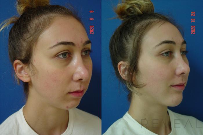 Before & After Chin Augmentation Case 443 View #4 View in San Jose, CA