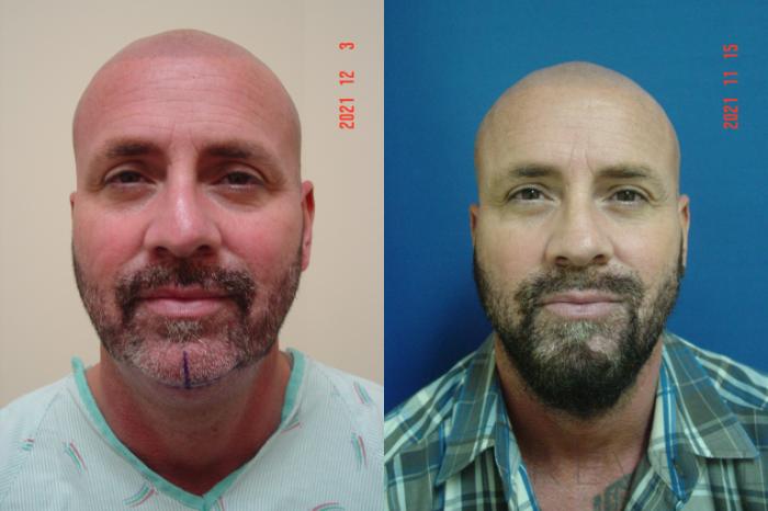 Before & After Chin Augmentation Case 629 Front View in San Jose, CA