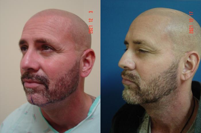 Before & After Chin Augmentation Case 629 Left Oblique View in San Jose, CA
