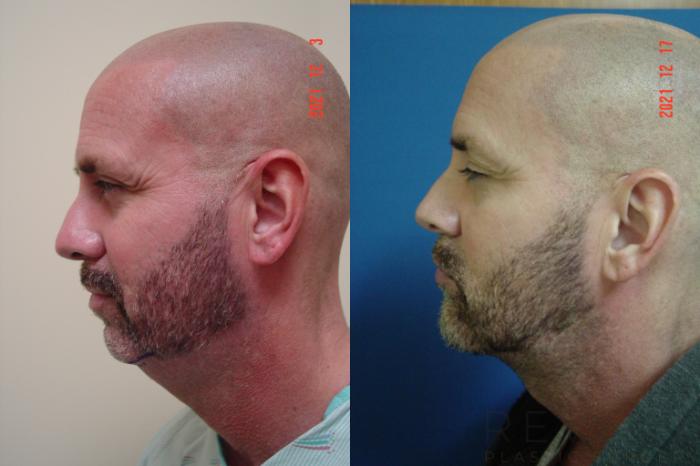 Before & After Chin Augmentation Case 629 Left Side View in San Jose, CA