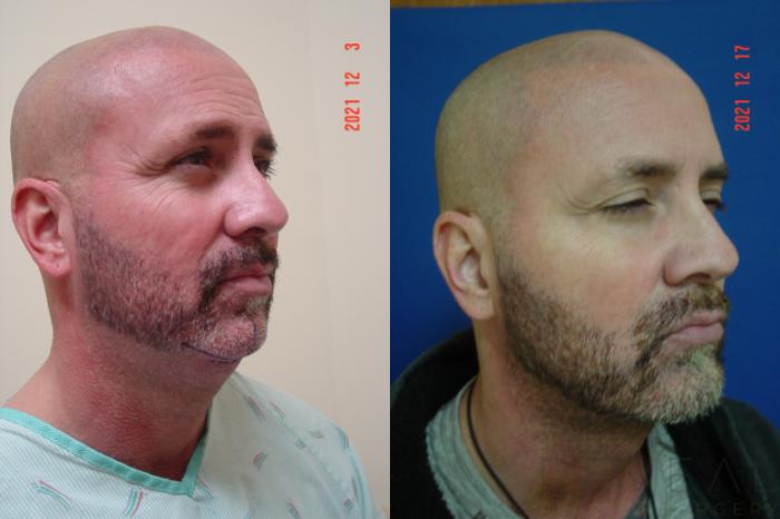 Before & After Chin Augmentation Case 629 Right Oblique View in San Jose, CA