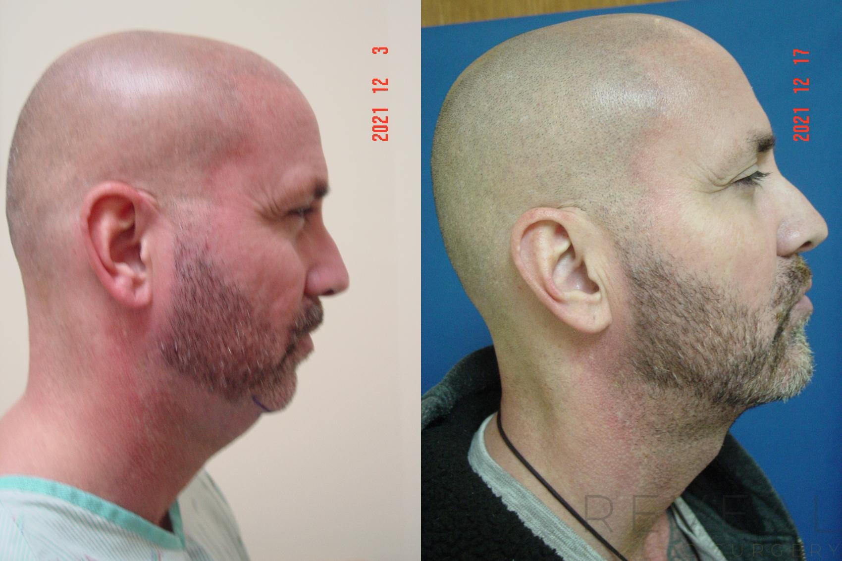 Before & After Chin Augmentation Case 629 Right Side View in San Jose, CA