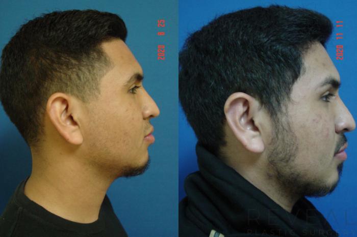 Before & After Ear Surgery Case 449 View #3 View in San Jose, CA