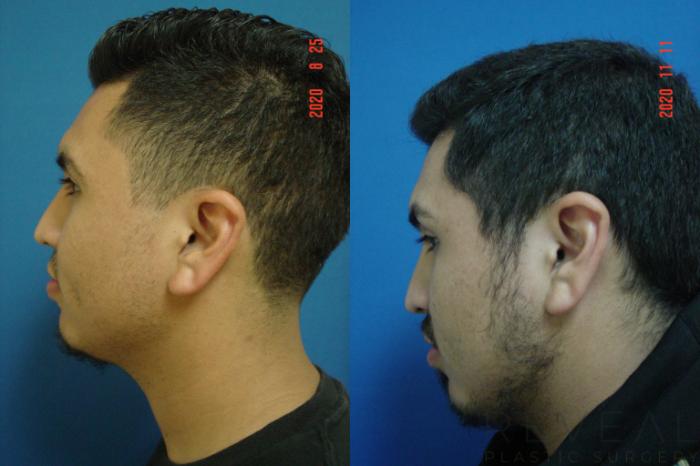 Before & After Ear Surgery Case 449 View #4 View in San Jose, CA