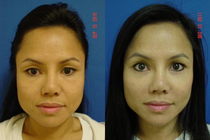 Before & After Eyelid Surgery Case 120 View #1 View in San Jose, CA