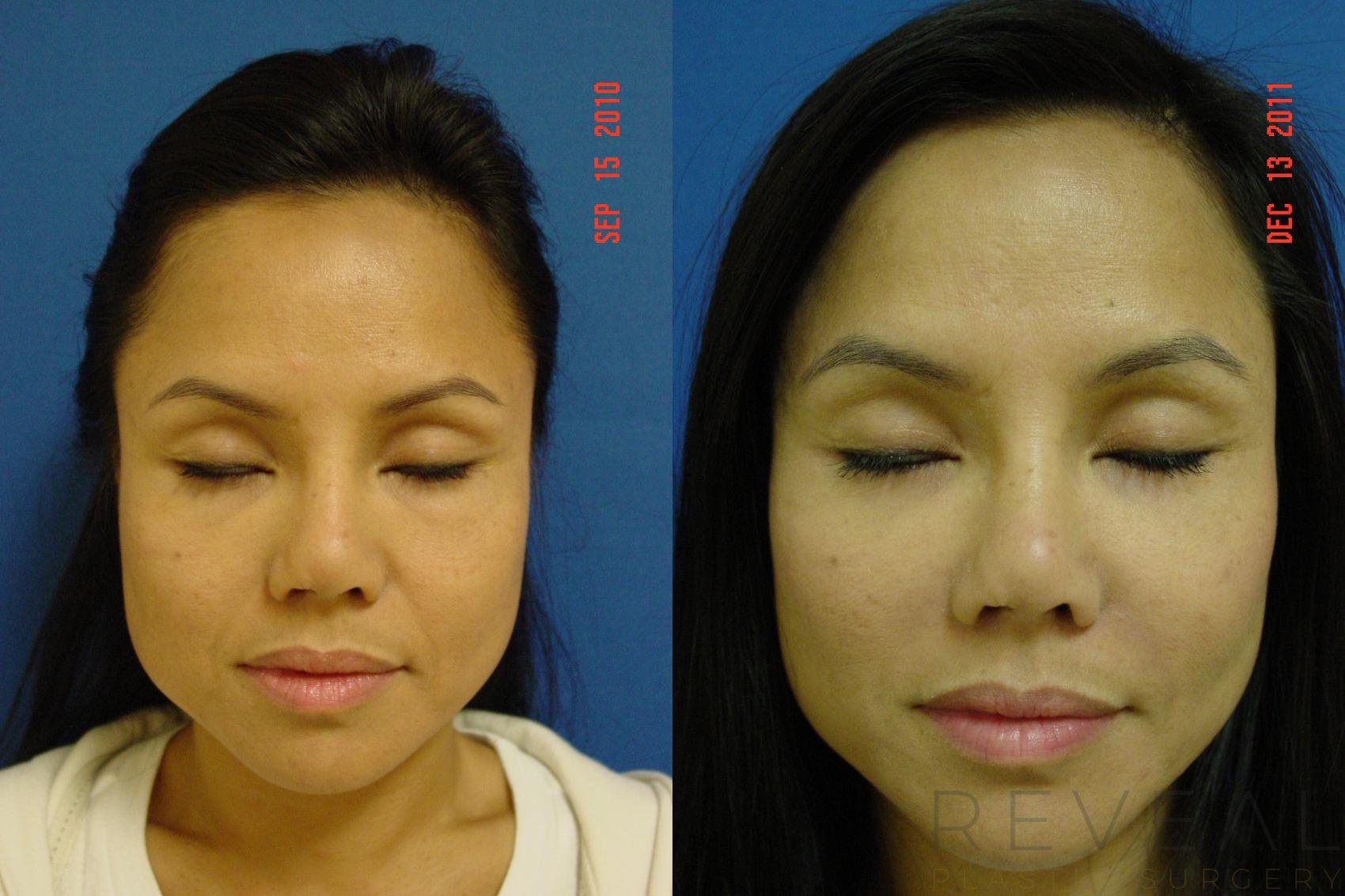 Before & After Eyelid Surgery Case 120 View #2 View in San Jose, CA