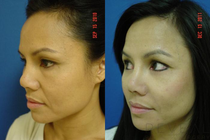 Before & After Eyelid Surgery Case 120 View #3 View in San Jose, CA