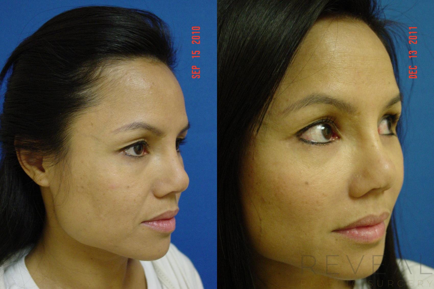 Before & After Eyelid Surgery Case 120 View #4 View in San Jose, CA