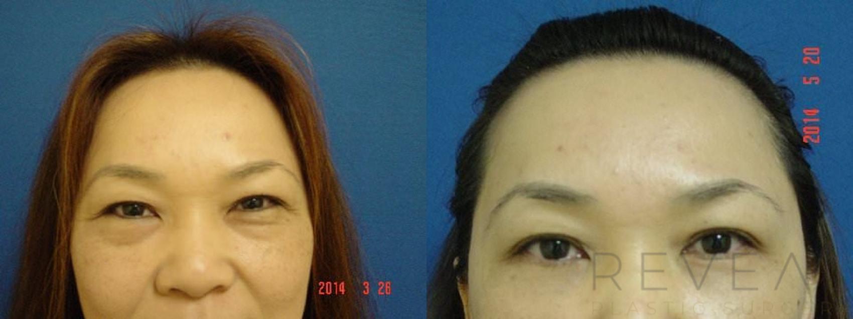 Before & After Eyelid Surgery Case 146 View #1 View in San Jose, CA