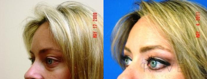 Before & After Eyelid Surgery Case 148 View #1 View in San Jose, CA