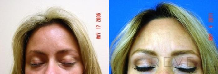 Before & After Eyelid Surgery Case 148 View #2 View in San Jose, CA