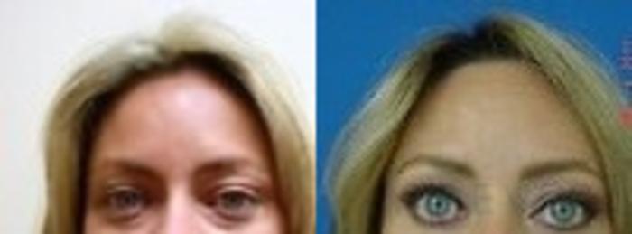 Before & After Eyelid Surgery Case 148 View #3 View in San Jose, CA