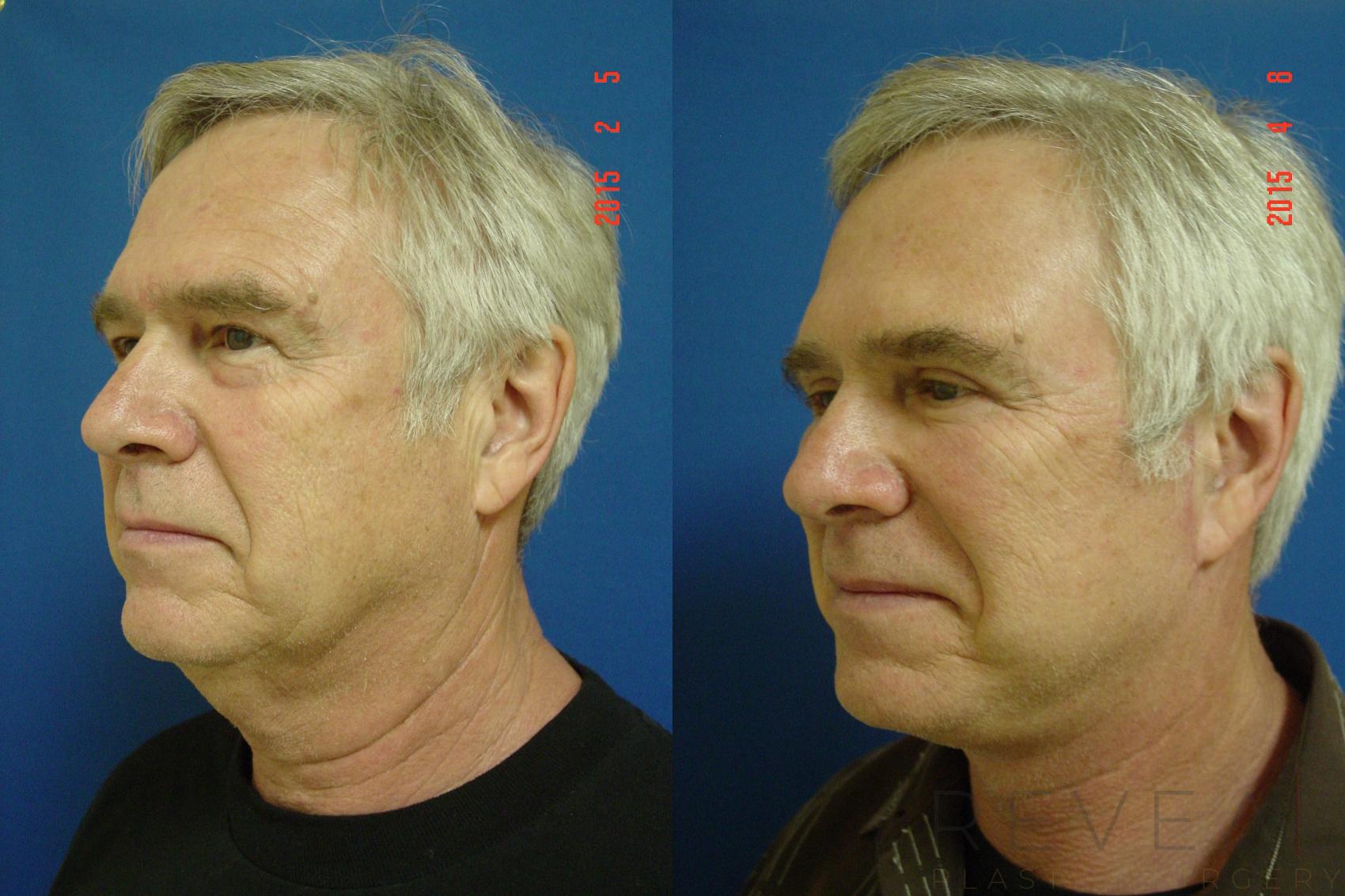 Before & After Eyelid Surgery Case 175 View #2 View in San Jose, CA