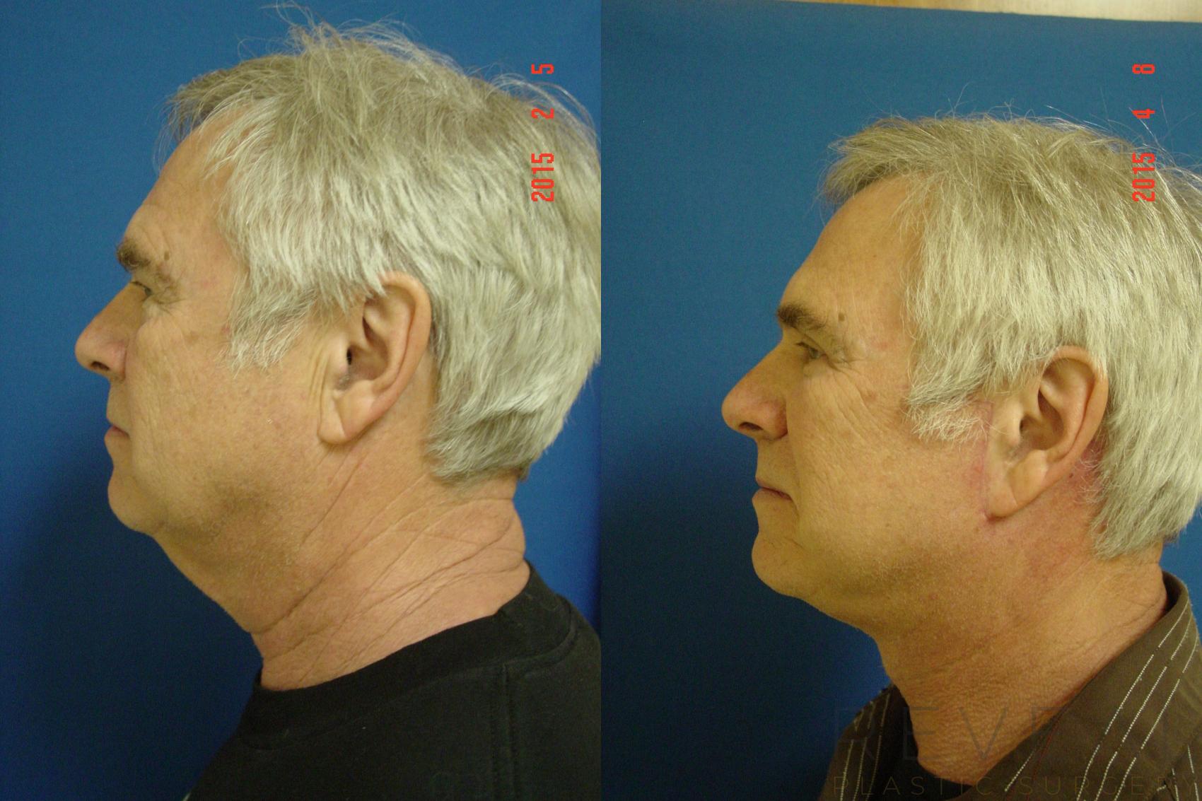 Before & After Eyelid Surgery Case 175 View #3 View in San Jose, CA