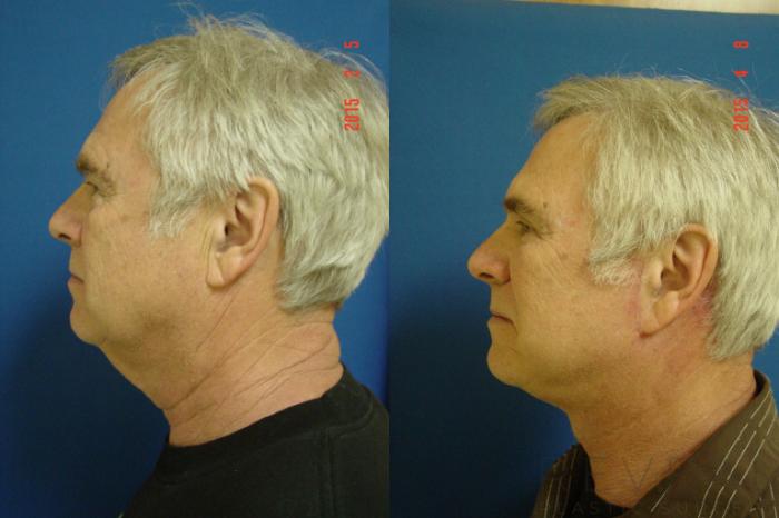 Before & After Facelift Case 175 View #3 View in San Jose, CA