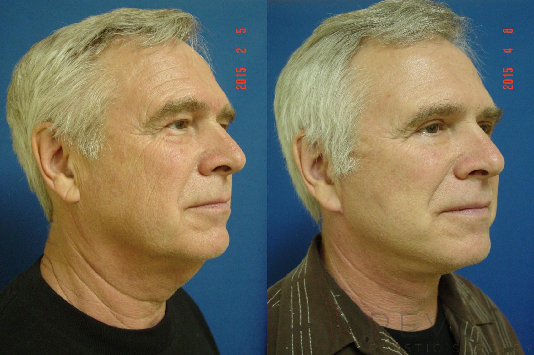 Before & After Eyelid Surgery Case 175 View #4 View in San Jose, CA