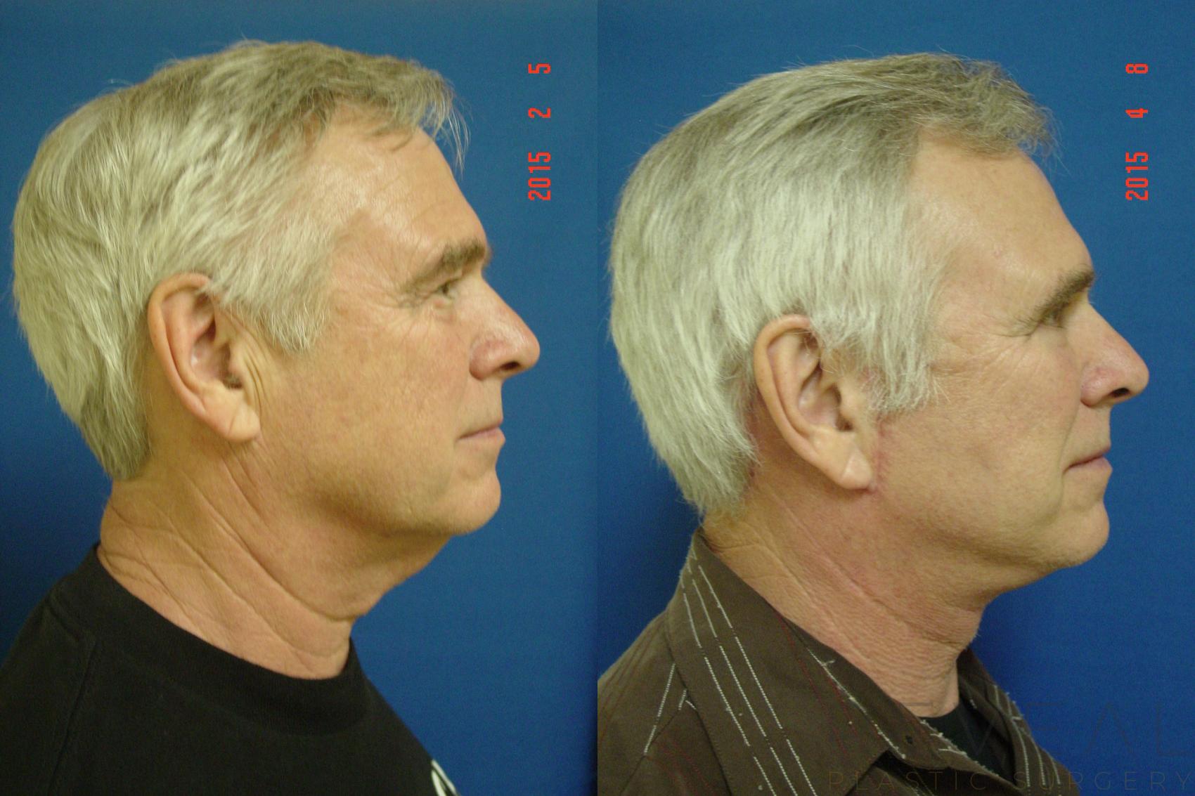 Before & After Eyelid Surgery Case 175 View #5 View in San Jose, CA