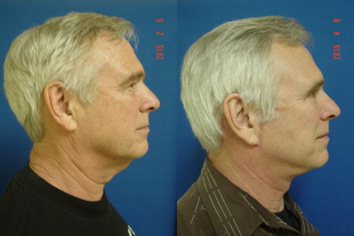 Before & After Neck Lift Case 175 View #5 View in San Jose, CA