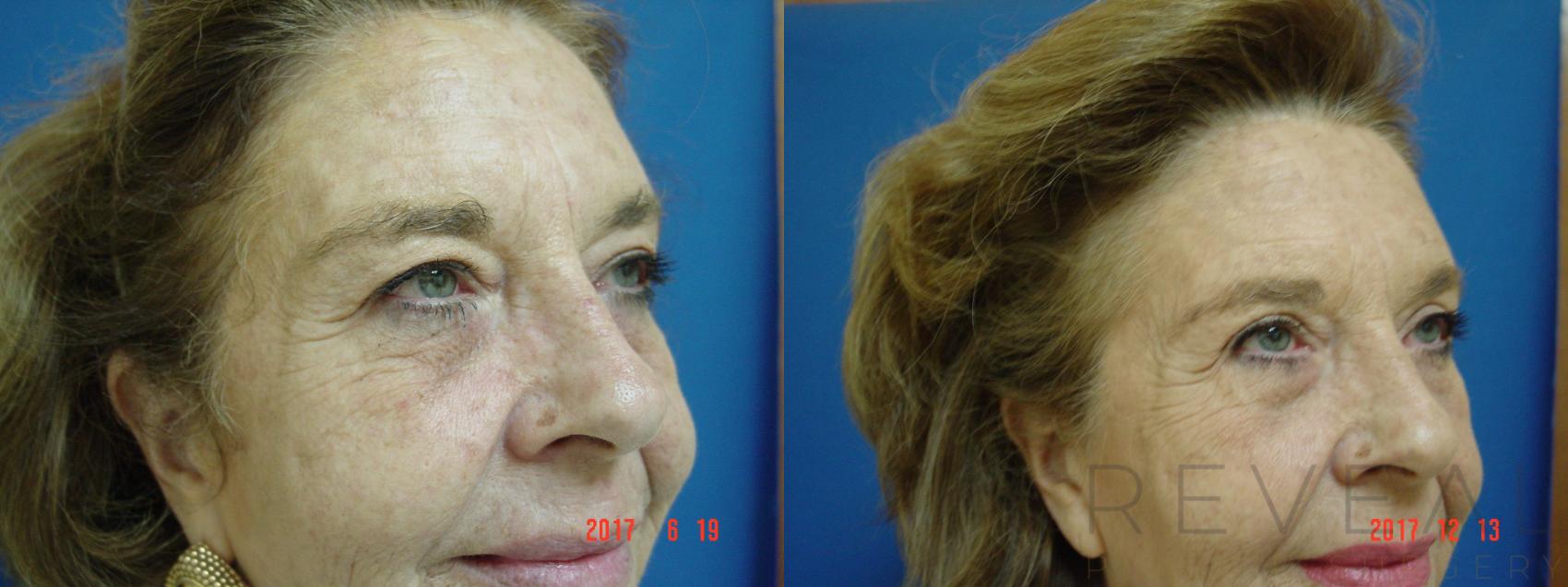 Before & After Eyelid Surgery Case 236 View #1 View in San Jose, CA